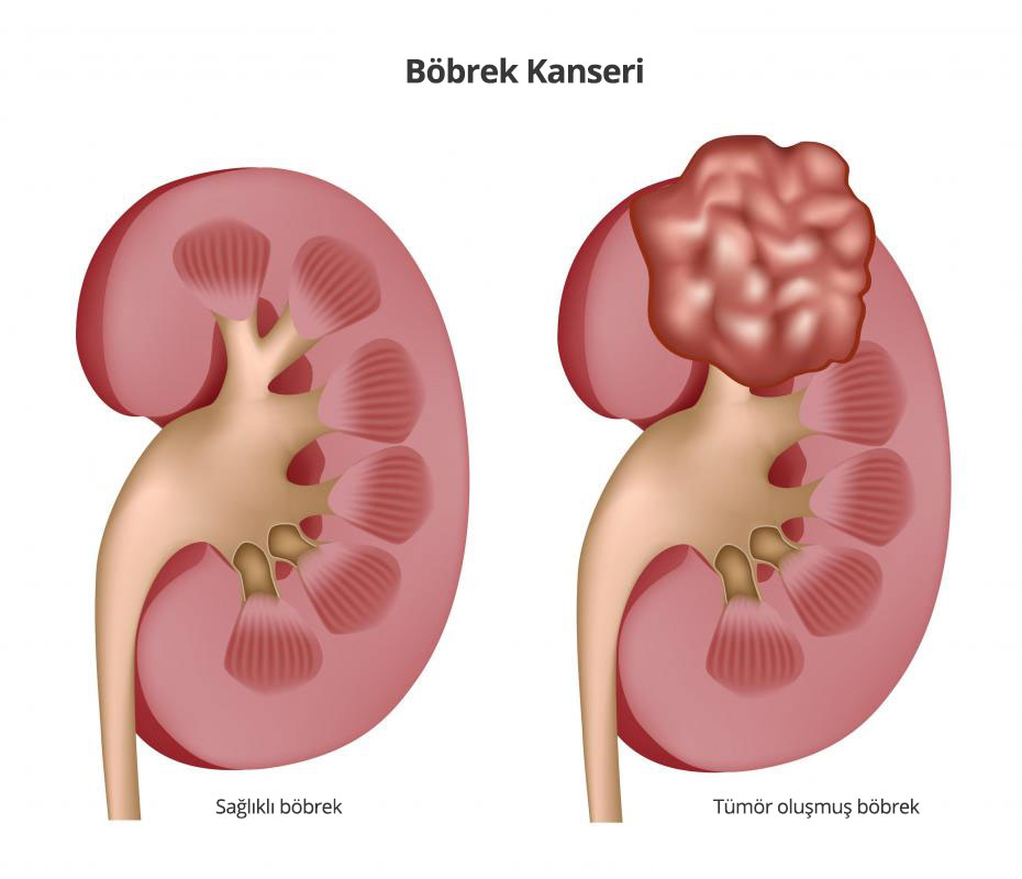 Böbrek Kanseri - Prof. Dr. Bülent Önal Böbrek Kanseri - Prof. Dr. Bülent Önal