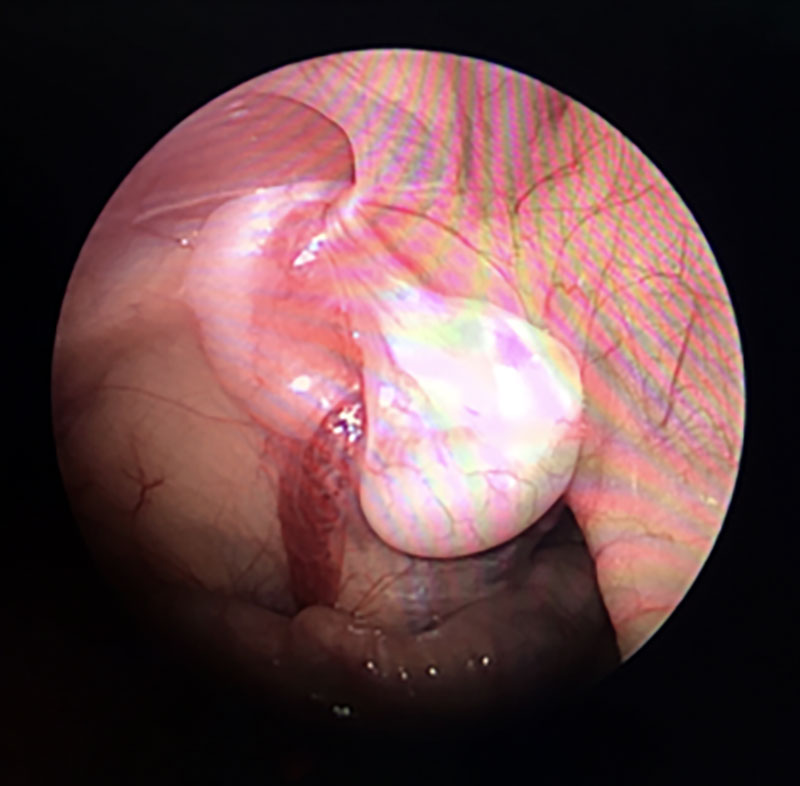 İnmemiş testis - Prof. Dr. Bülent Önal İnmemiş testis - Prof. Dr. Bülent Önal