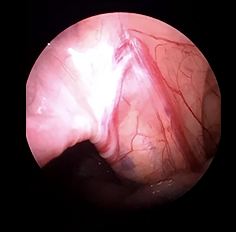 İnmemiş testis - Prof. Dr. Bülent Önal İnmemiş testis - Prof. Dr. Bülent Önal