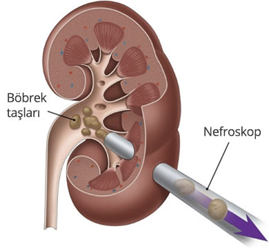 PCNL - Böbrek Taşı Tedavisi - Prof. Dr. Bülent Önal PCNL - Böbrek Taşı Tedavisi - Prof. Dr. Bülent Önal